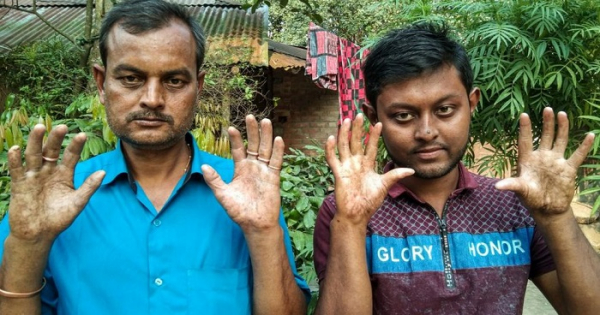 নাটোরে ফিঙ্গারপ্রিন্ট বিহীন বিরল পরিবারটির গল্প শুনুন
