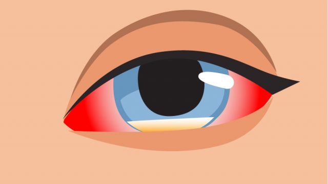 খুলনায় করোনা থেকে সেরে ওঠা রোগী ‘ব্ল্যাক ফাঙ্গাসে’ আক্রান্ত